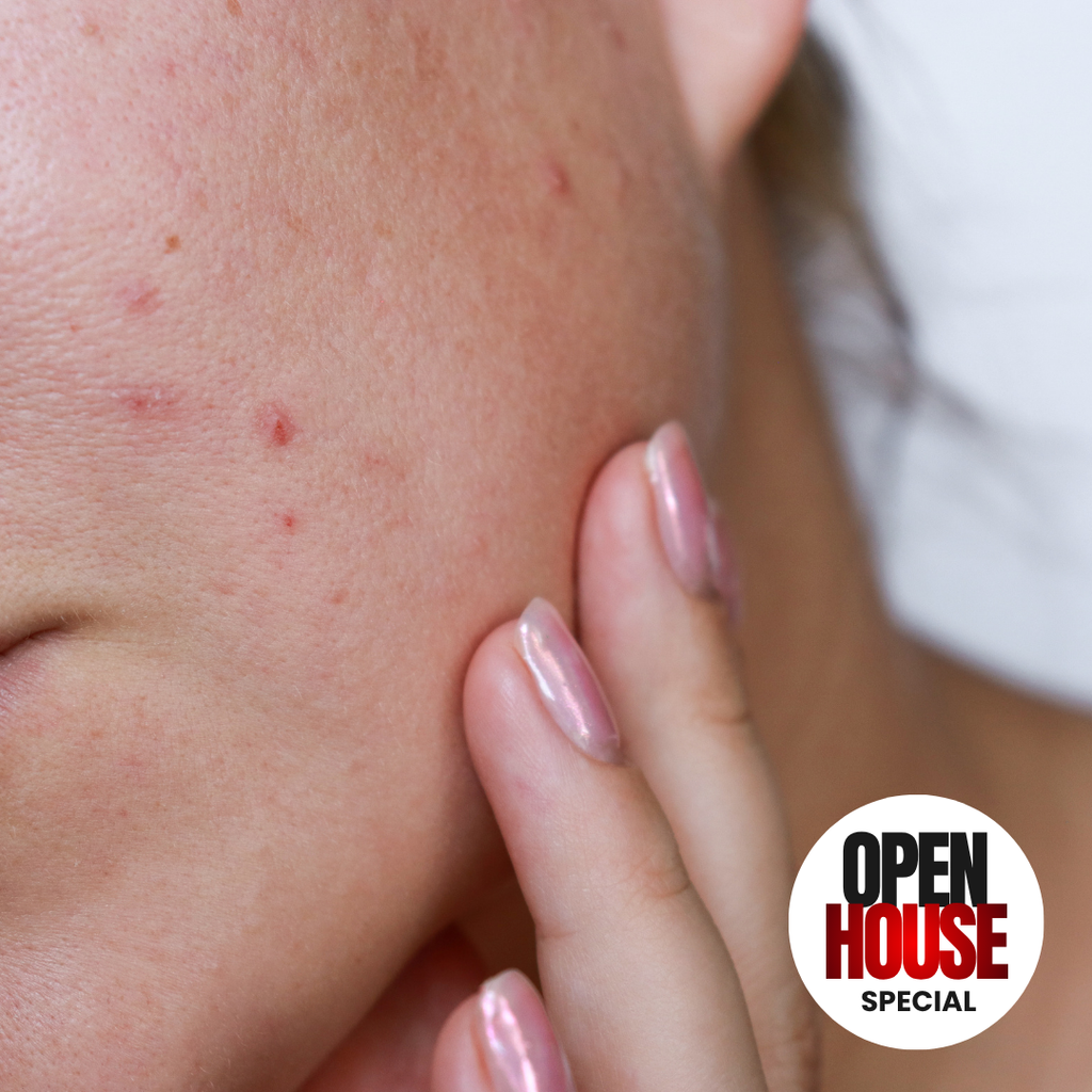 PRISM ACNE FACIAL: 60 MINUTE