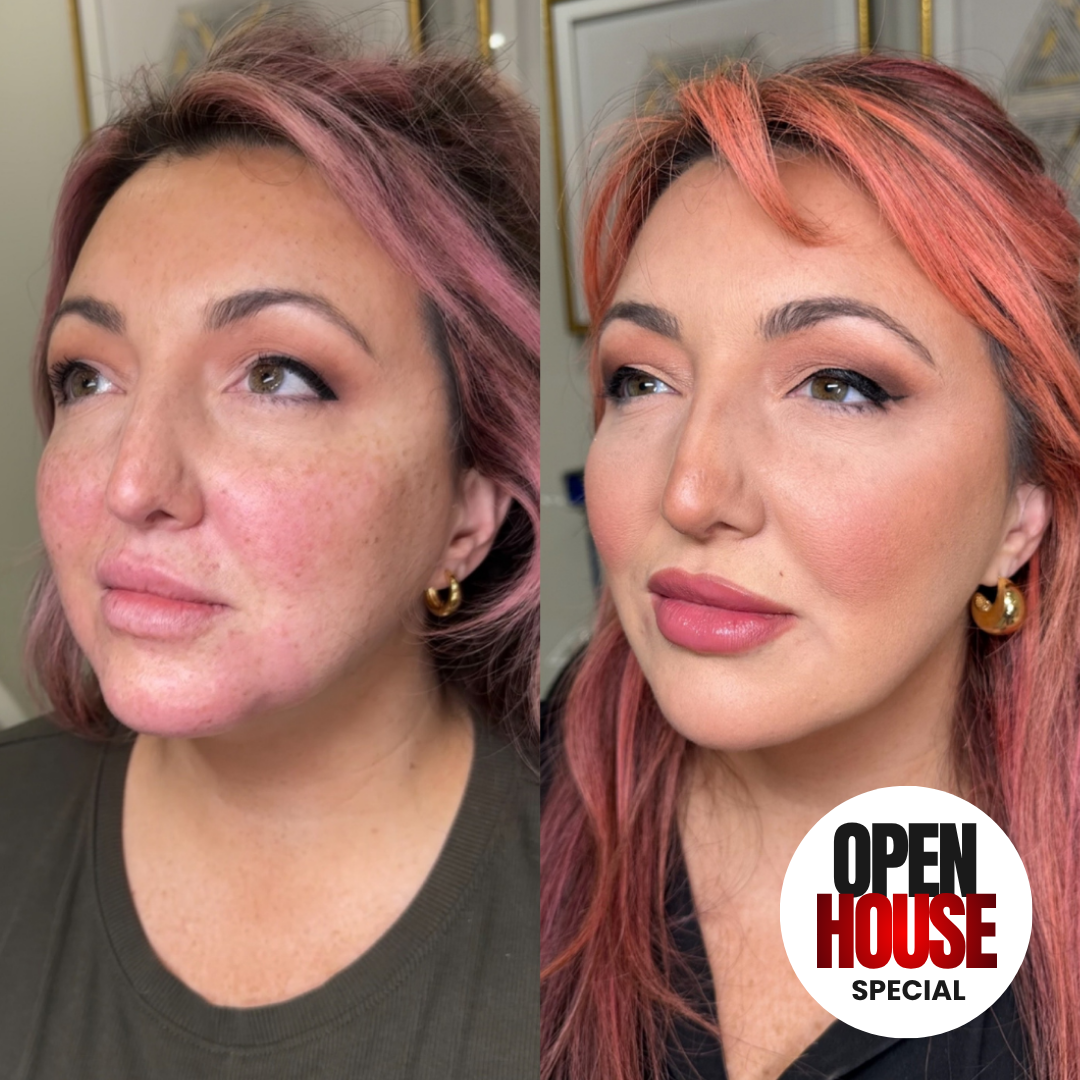 INJECTABLES: 3D LIQUID FACELIFT + 30 UNITS OF TOX