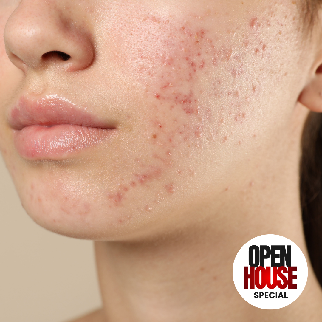PRISM PRE-TEEN ACNE FACIAL: 45 MINUTE