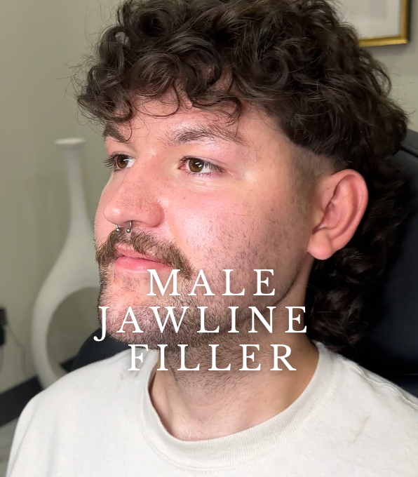 INJECTABLES: MALE JAWLINE FILLER + 30 UNITS OF TOX