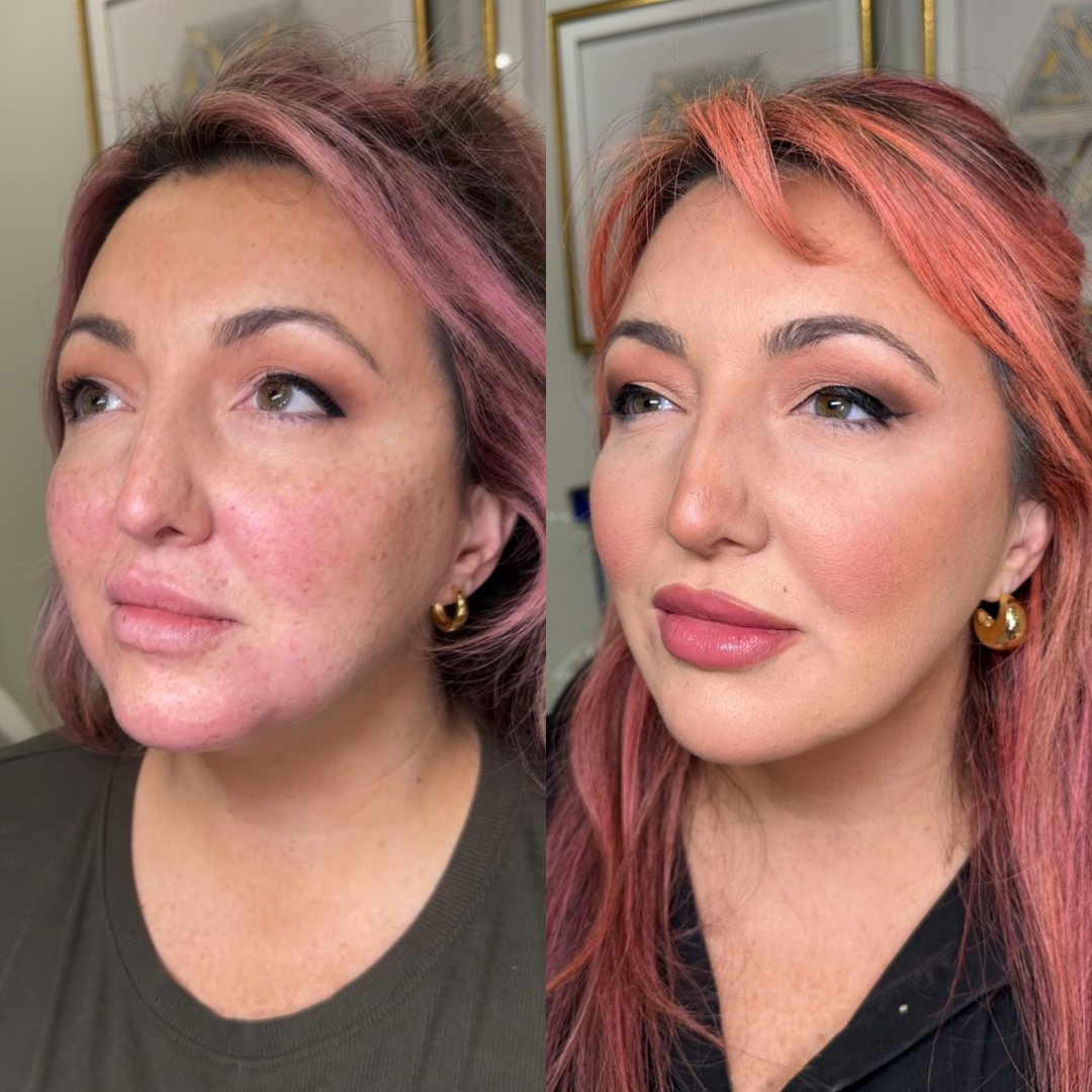 INJECTABLES: 3D LIQUID FACELIFT + 50 UNITS OF LETYBO